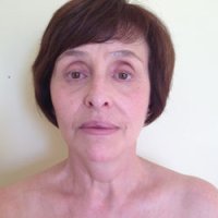Facelift - necklift